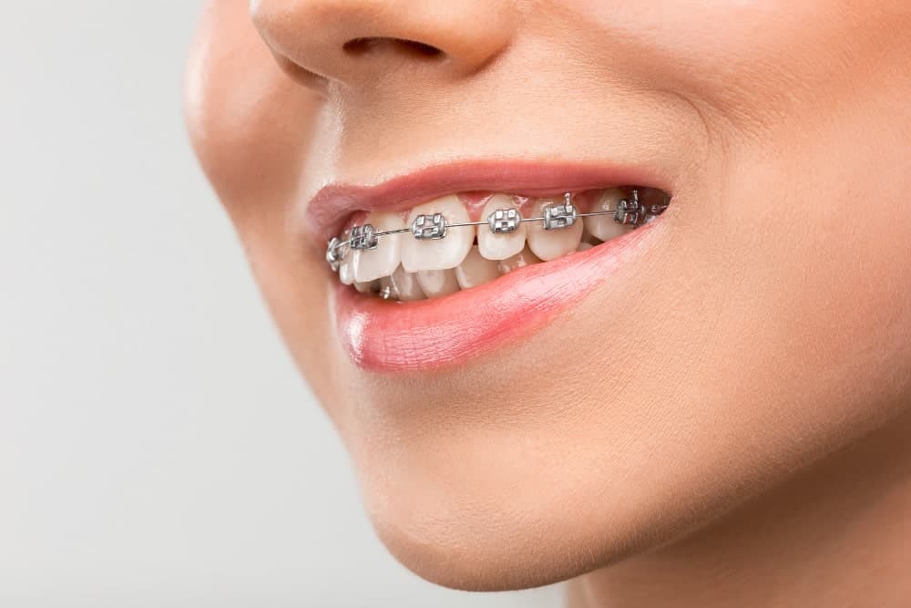 ortodoncia en dentistas
